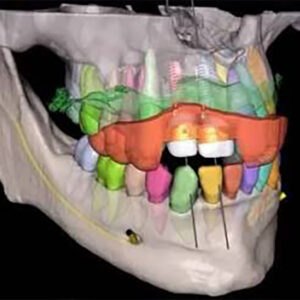 Planejamento de Reabilitação com Múltiplos Implantes